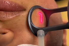 Laser CO2 Fractional RF Technician training at BC Medical Clinic