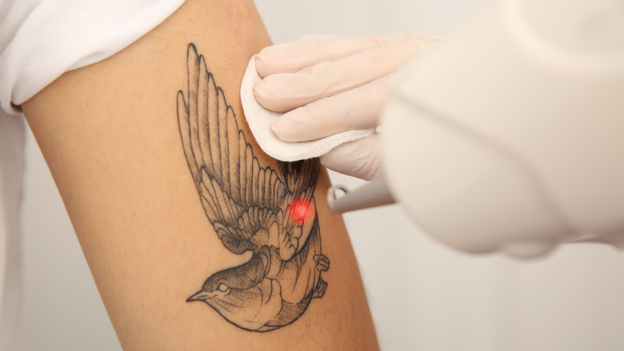 Laser Tattoo Removal